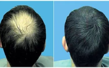 Rahasia Cantik Berikan Solusi Obat Penumbuh Rambut untuk Kaum Hawa