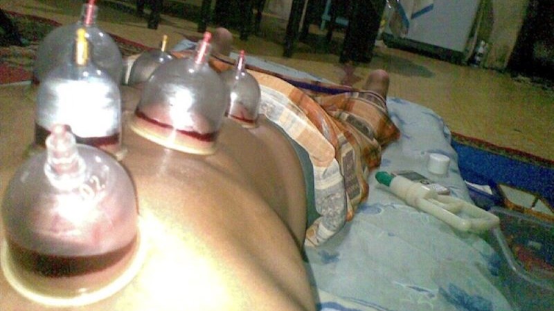 Proses Pengobatan Bekam di Pontianak