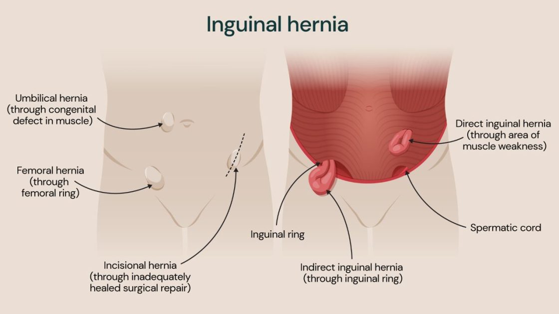 Penyakit Hernia Inguinalis