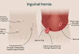 Penyakit Hernia Inguinalis