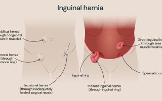 Penyakit Hernia Inguinalis